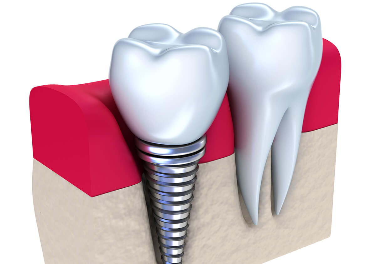 Secure Your Smile with Long-lasting and Natural-looking Dental Implants