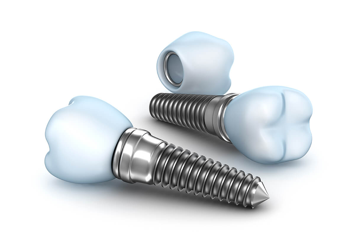 Want the Look and Feel of Natural Teeth? Try Dental Implants