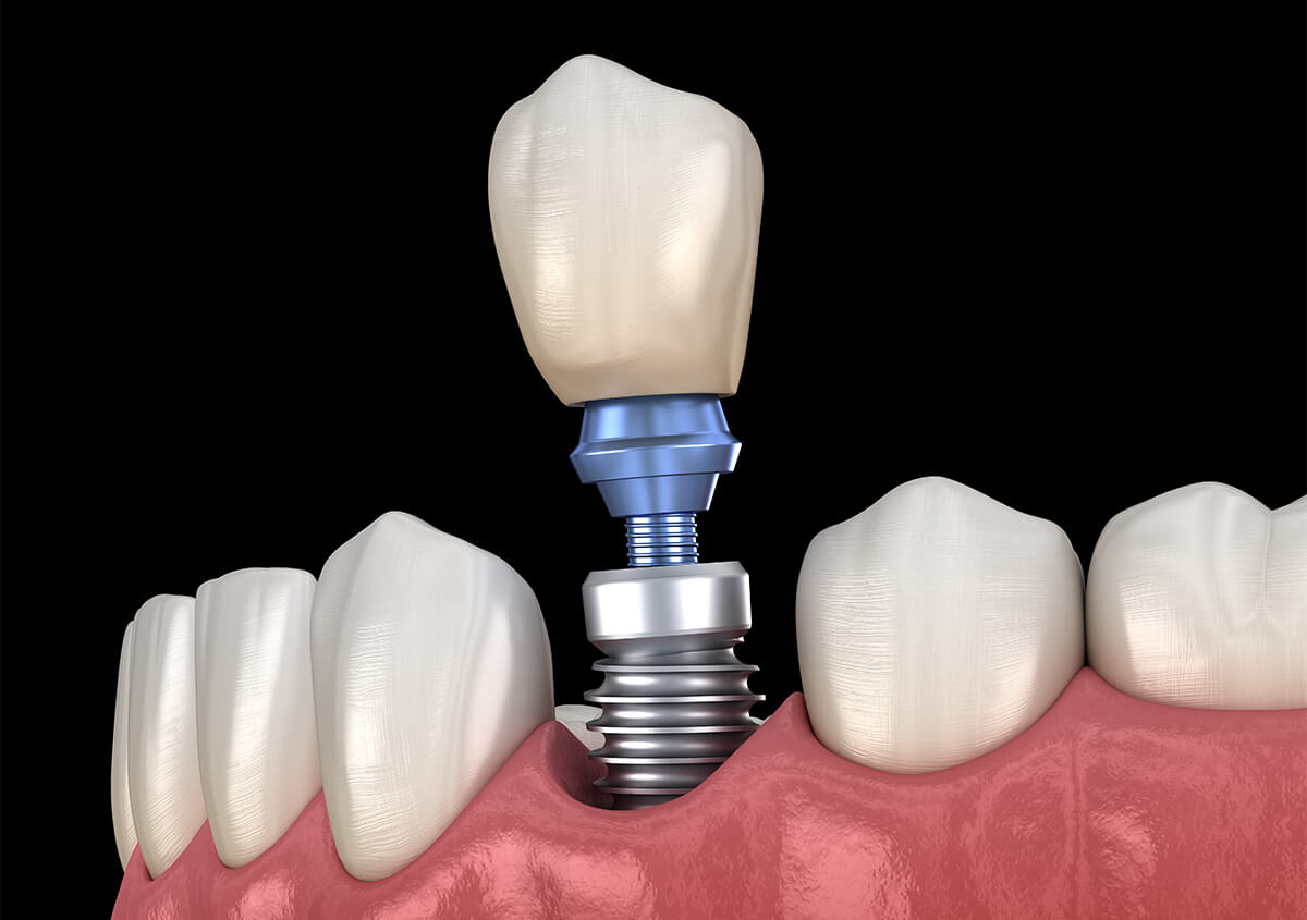 For Highly Functional Replacement Teeth, You Can’t Beat Dental Implants