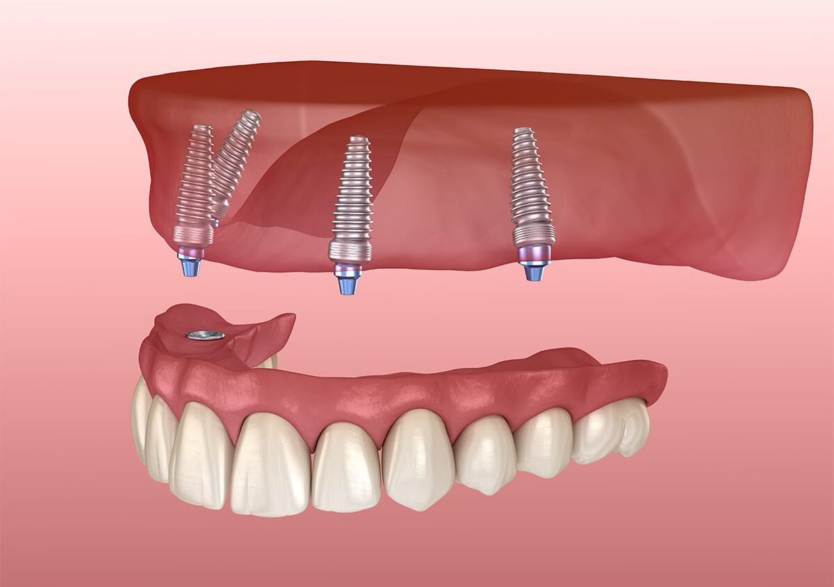 Everything You Need to Know About All on Four Dental Implants