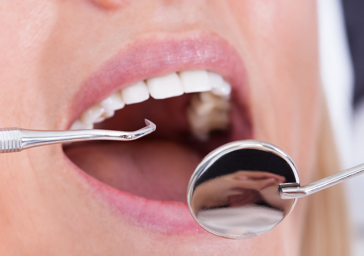 Benefits of a Professional Teeth Cleaning Service